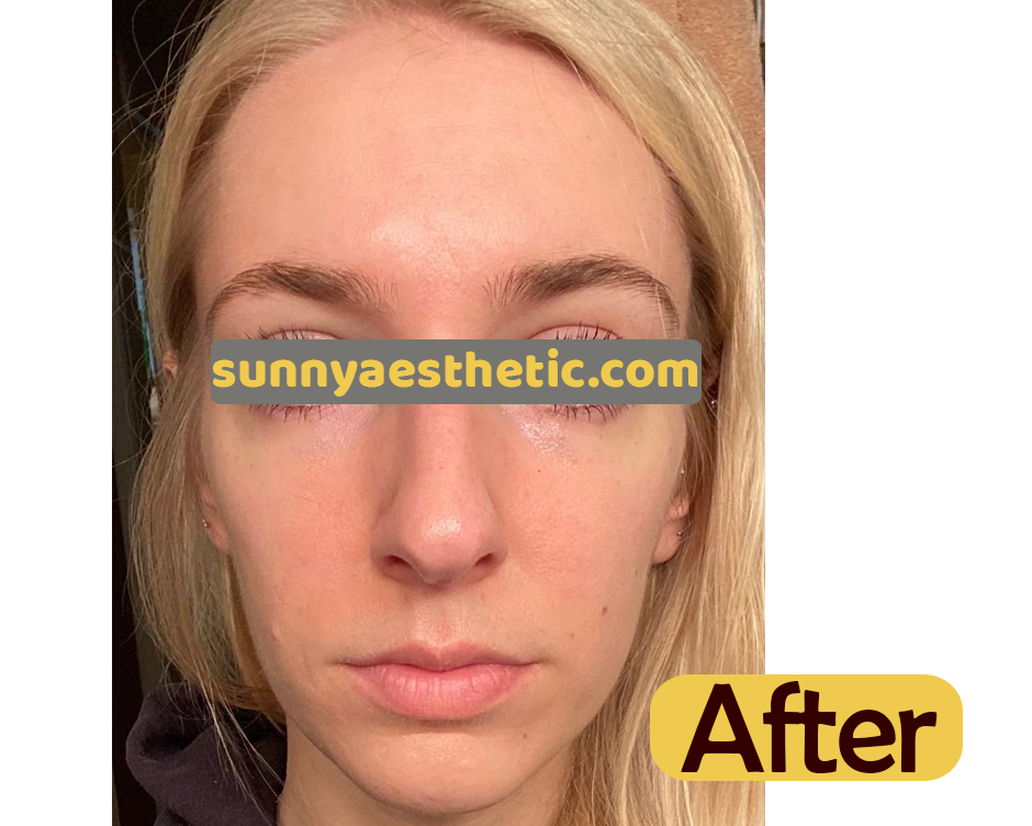 Microneedling PRP Before/after pictures