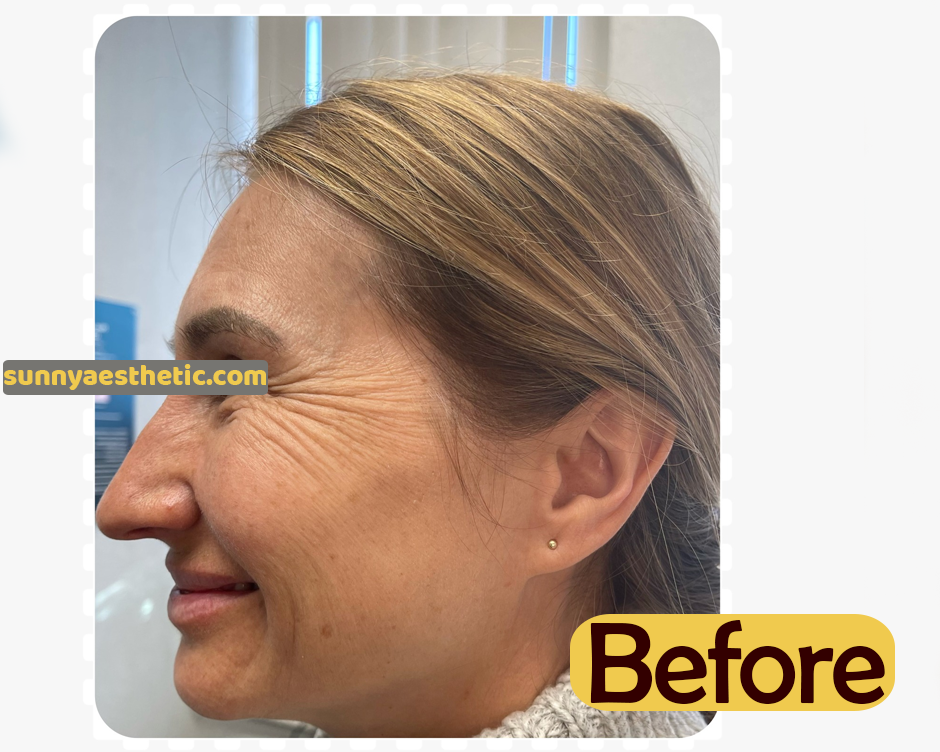 Botox/beforeafter