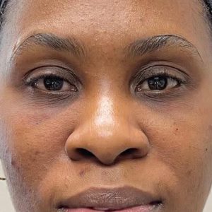 Under Eyes Treatment after picture