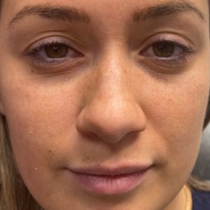 Under Eyes Treatment Before picture