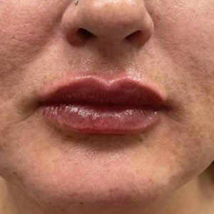 Sunny Aesthetic - Lip filler After picture