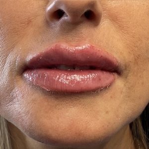 Sunny Aesthetic - Lip filler After picture