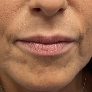 Sunny Aesthetic - Lip filler before picture