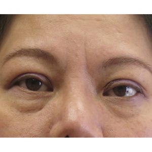Sunny Aesthetic- Under Eyes treatment before picture