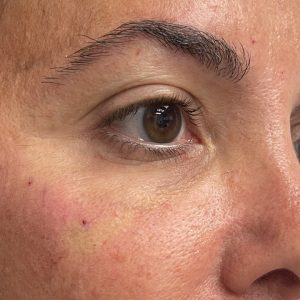 Sunny Aesthetic- Under Eyes treatment After picture