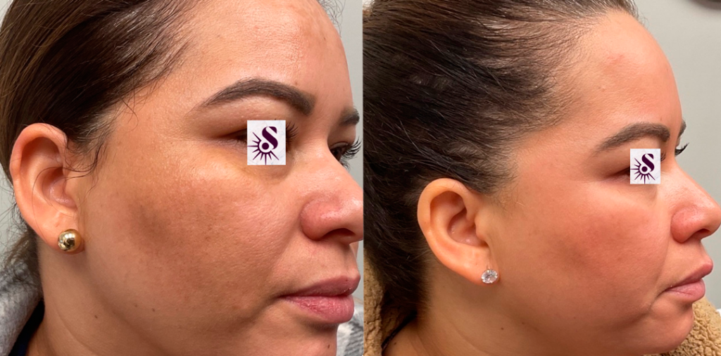 Before and after picture of a Melasma Treatment