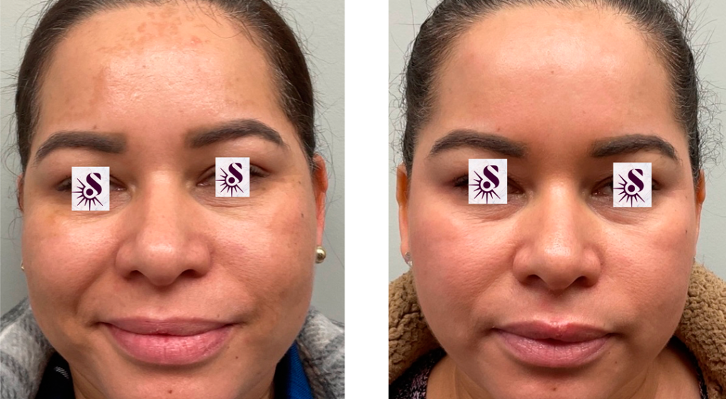 Before and after Picture of Melasma treatment