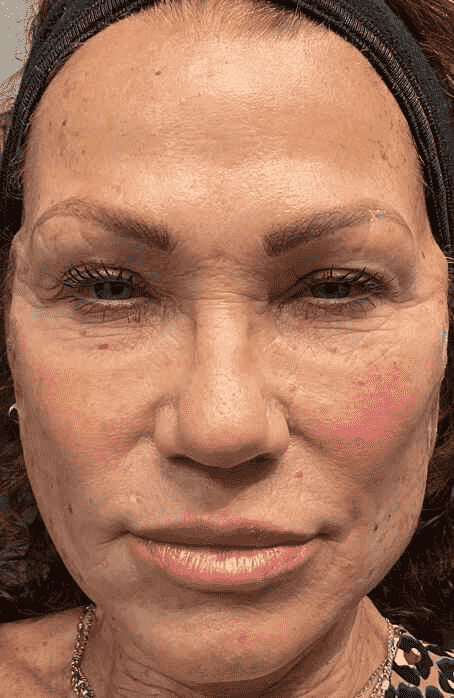 Women after skin rejuvenation-1