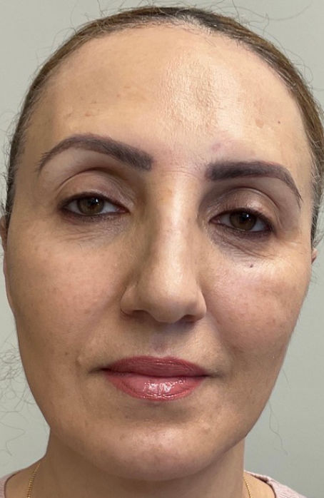 Women after skin rejuvenation-face-2