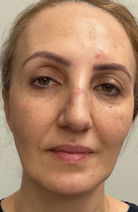 Women before skin rejuvenation-Face-2