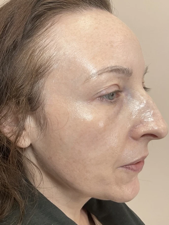erbium laser treatment after picture