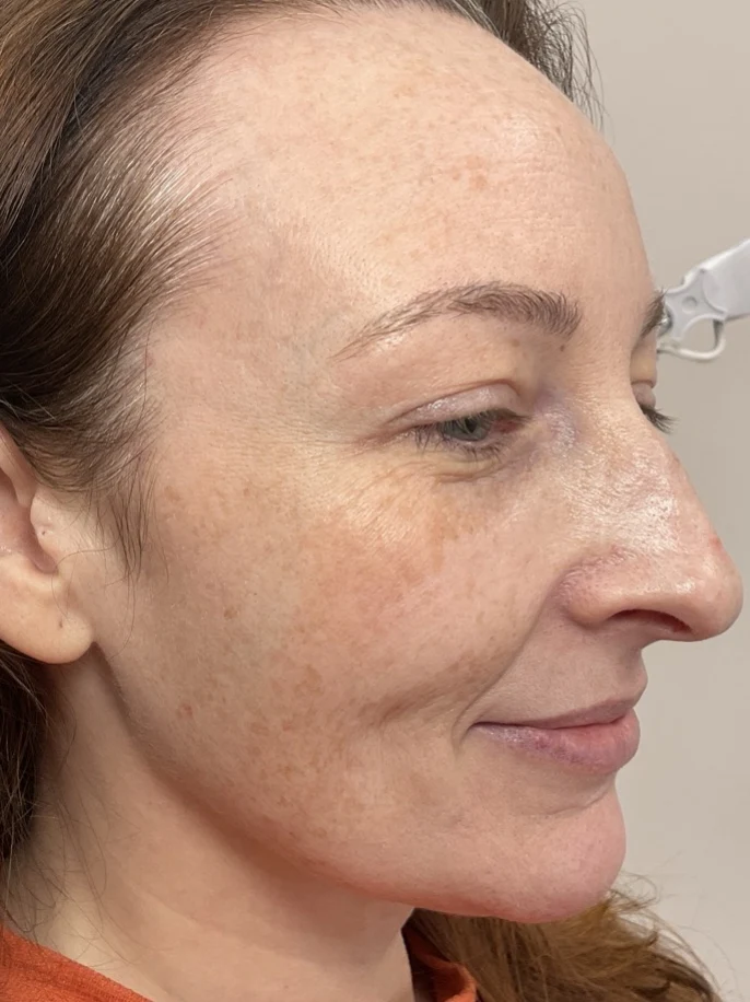 erbium laser treatment before picture