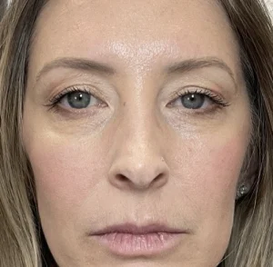 After under eyes treatment pictures