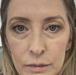 Before under eyes treatment picture