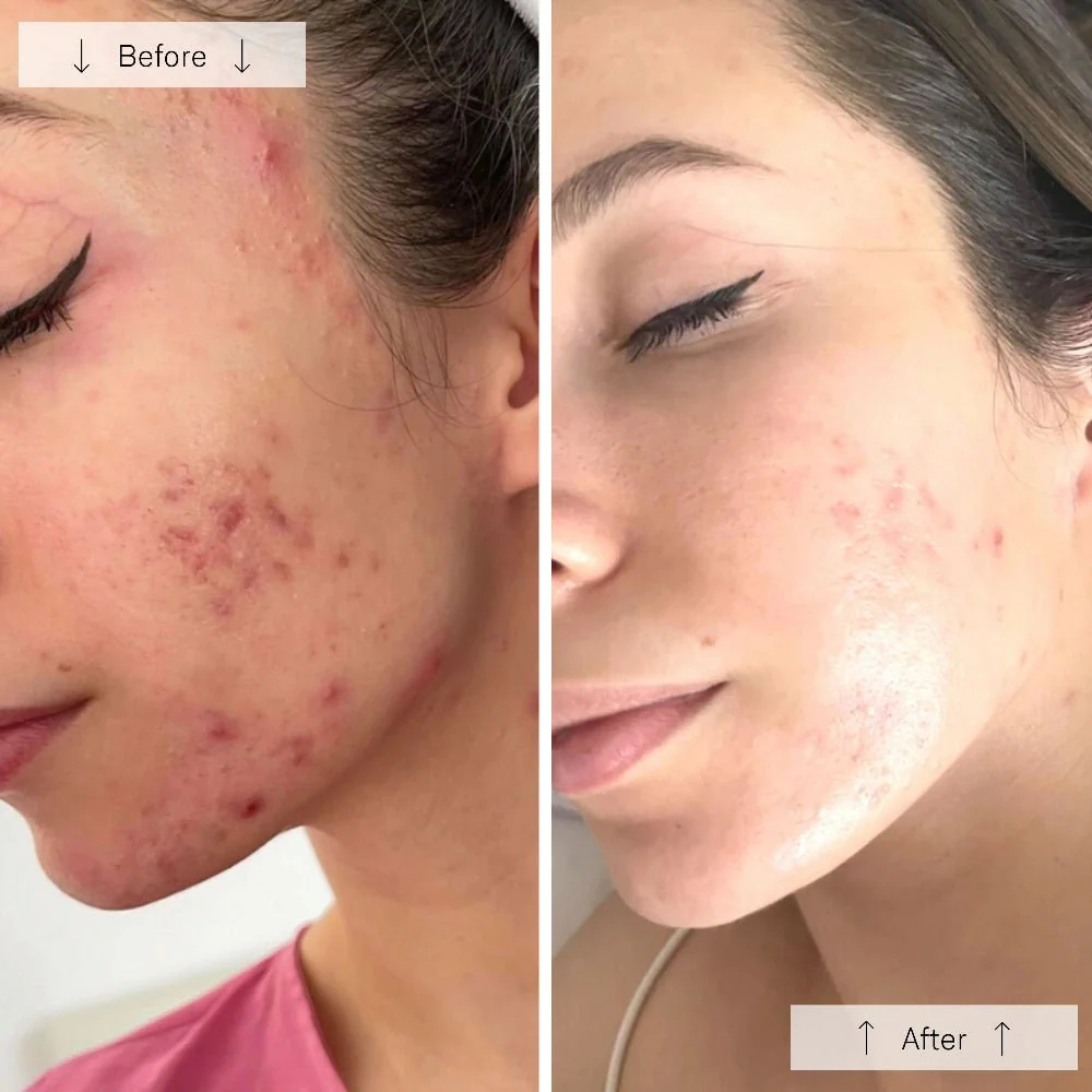 Omnilux Clear LED Mask Before/After