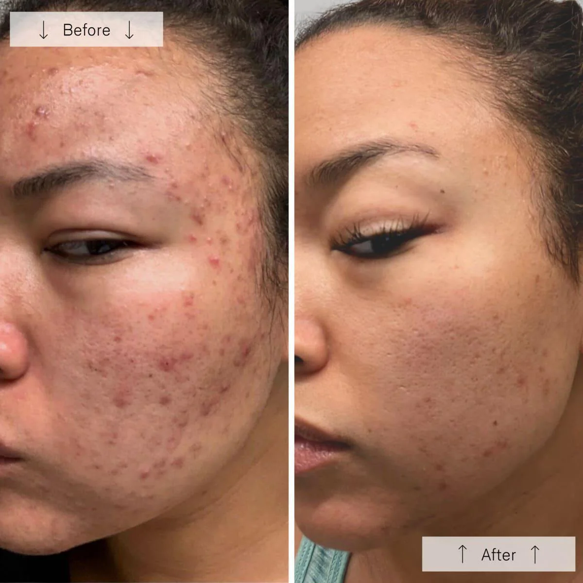 Omnilux Clear LED Mask Before/After