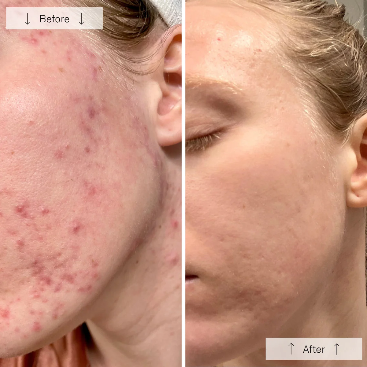 Omnilux Clear LED Mask Before/After