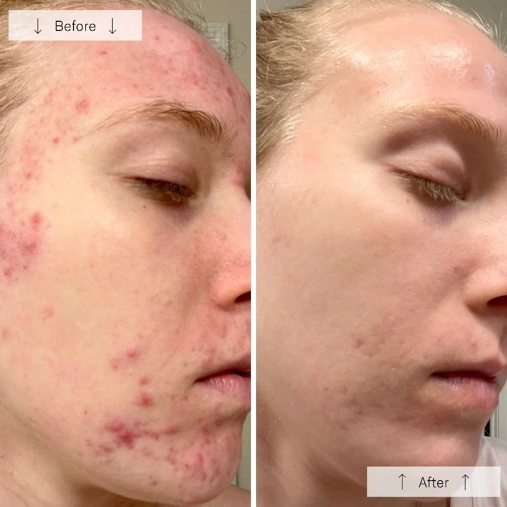 Omnilux Clear LED Mask Before/After